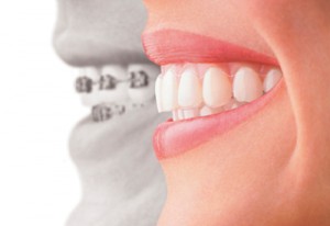 sacramento-invisalign